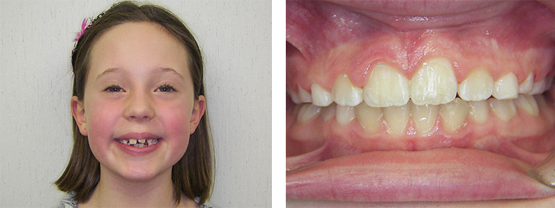 phase 1 cross bite