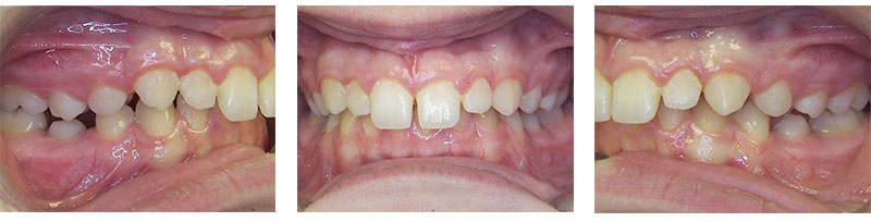 Correction of overbite