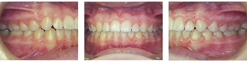 Correction of overbite