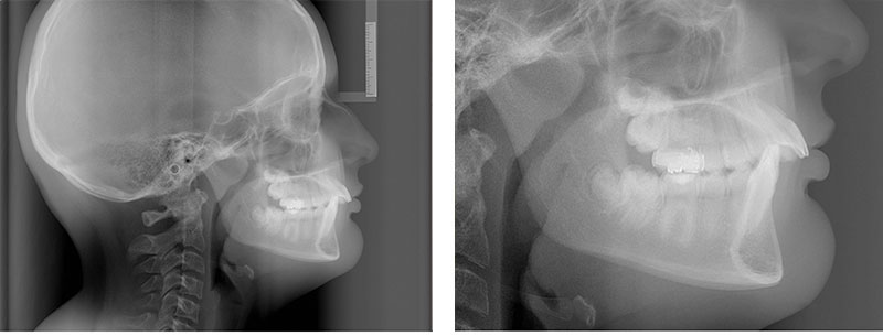 Correction of severe overbite