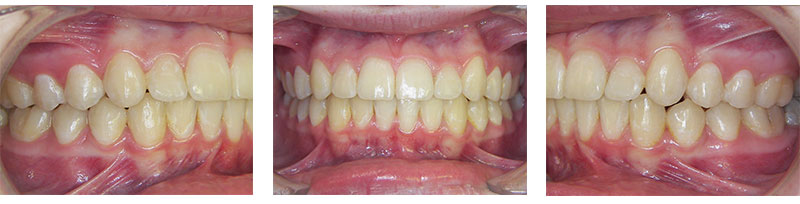 Correction of severe overbite