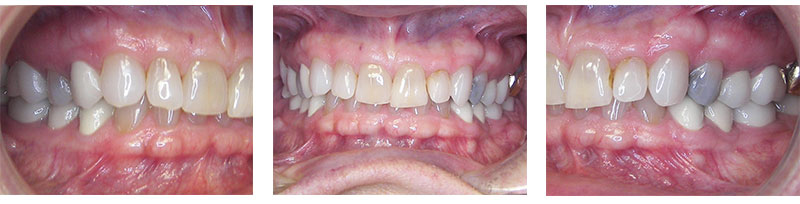 Adult Treatment Overbite