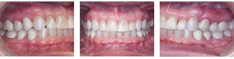 Adult Treatment Overbite