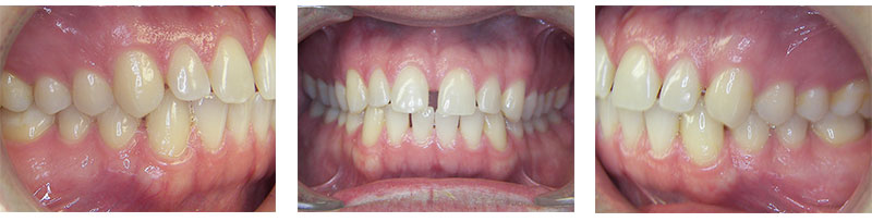 Adult Treatment Invisalign