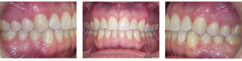 Adult Treatment Invisalign